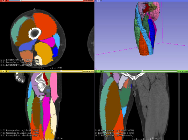 Segmenting muscles in 3dSlicer using the Visible Human Data Set.